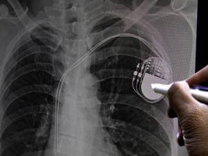 First-Line or Second Fiddle? Conduction System Pacing in HF