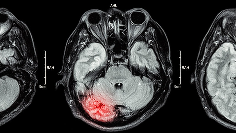 Potential Genes Identified for Posttraumatic Headache