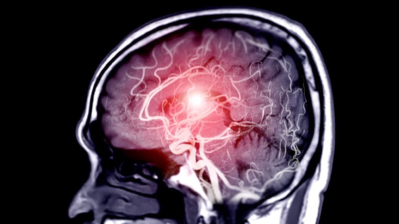 OAC, AF, and Recurrent Stroke Risk: New Data