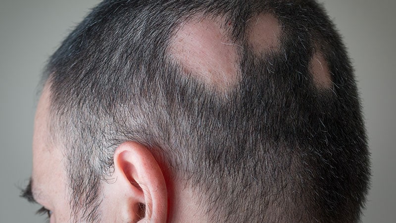 FDA Approves JAK Inhibitor for Alopecia Areata