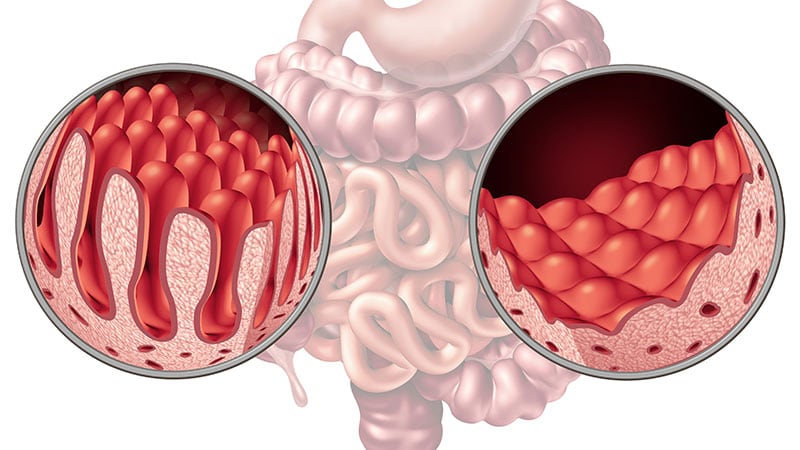 Celiac Disease: No-Biopsy Diagnosis Appears Effective