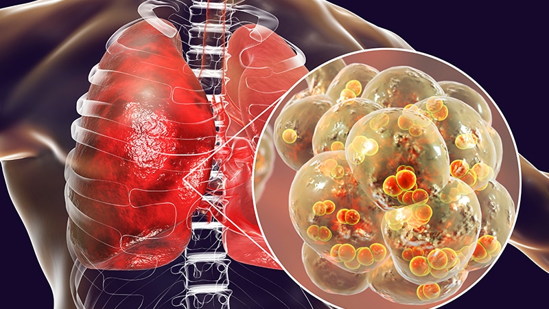 Specific Antipsychotics Linked to Increased Pneumonia Risk