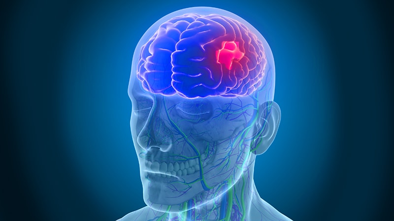 New Insight Into CVD, Stroke Risk in Migraine