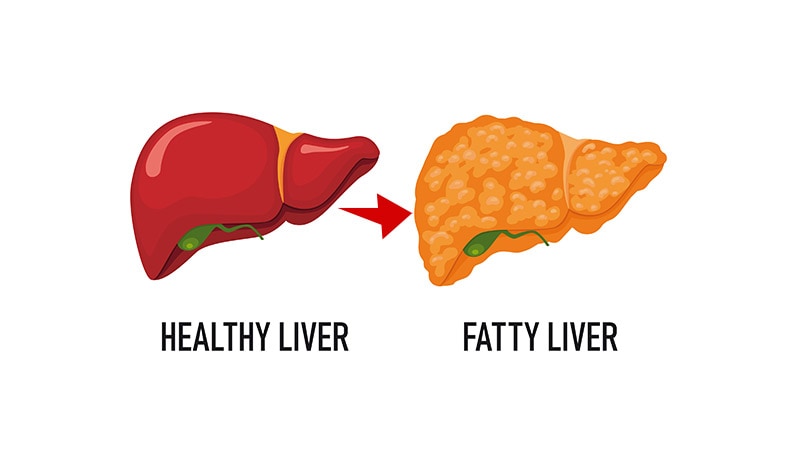 Noninvasive Method for Diagnosing Fatty Liver Developed