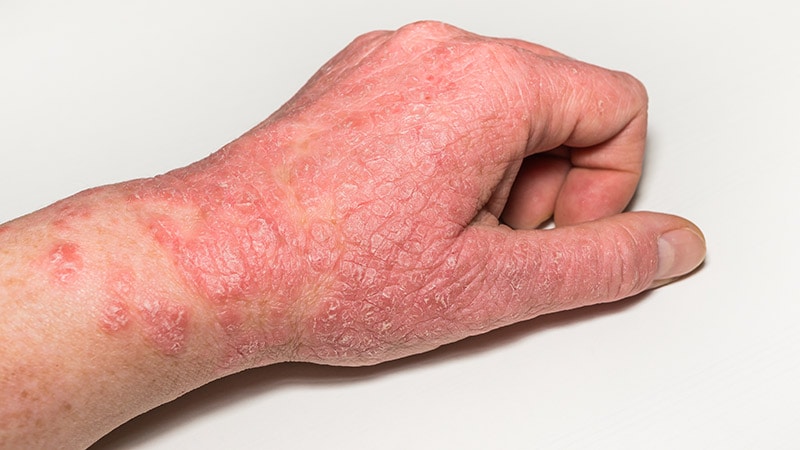 Delgocitinib Effective for Hand Eczema in Phase 3 Studies