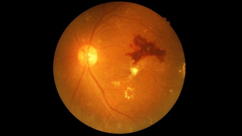 Are GLP-1s Bad for Retinas?