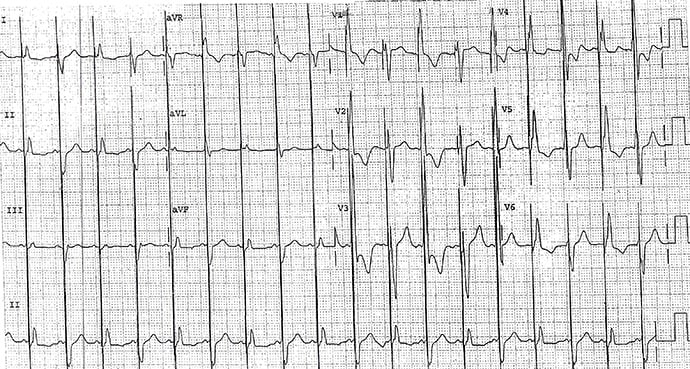 photo of Pacemaker