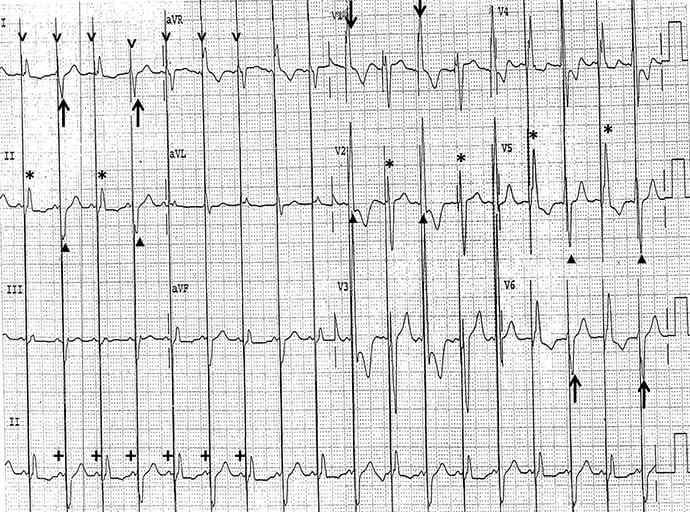 photo of Pacemaker