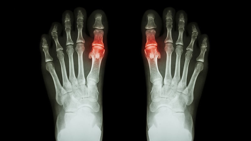 Nurse-Led Care for Gout Generates Best Uric Acid Control