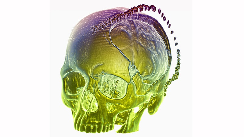 Decompressive Craniectomy Beneficial in Severe, Deep ICH